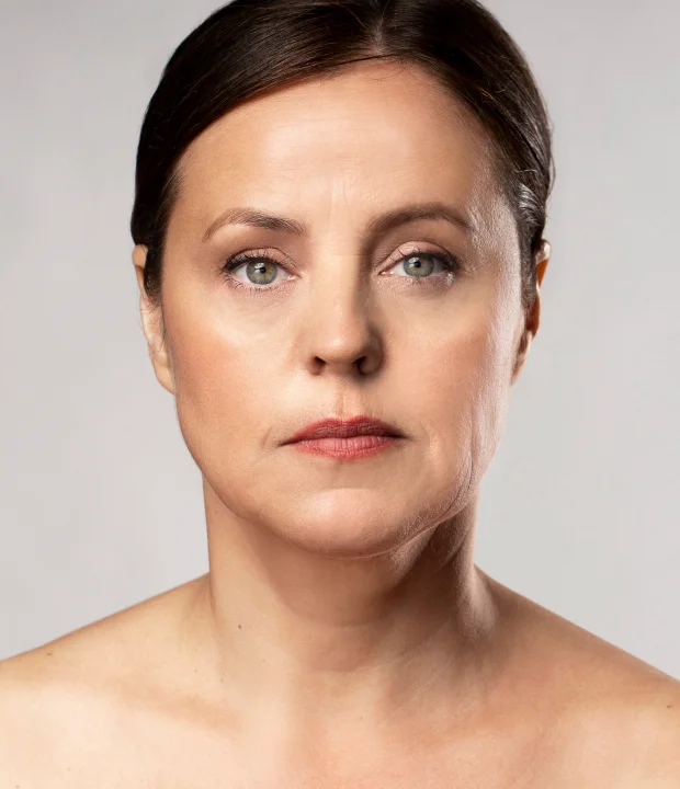 Preeling Químico - Clínica de Estética Soul Musa - Rejuvenescimento Facial