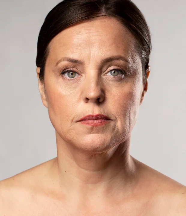 Preeling Químico - Clínica de Estética Soul Musa - Rejuvenescimento Facial