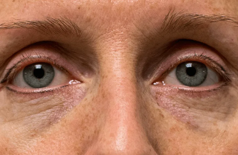 Jata de plasma antes e depois - clínica de estética Soul Musa