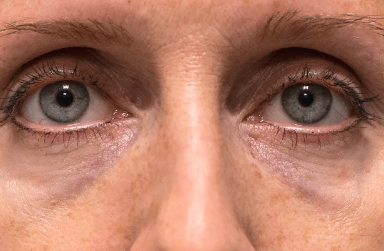 Jata de plasma antes e depois - clínica de estética Soul Musa