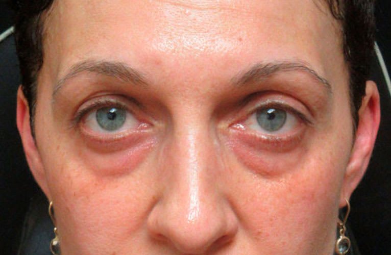 Tratamento para Olheiras e Bolsas - Soul Musa | Clínica de Estética Vila Andrade Morumbi Tratamento para Olheiras e Bolsas Antes e Depois