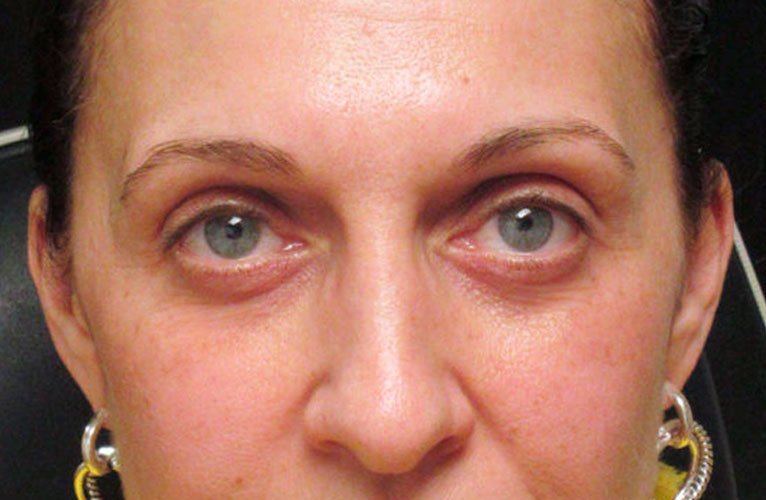 Tratamento para Olheiras e Bolsas - Soul Musa | Clínica de Estética Vila Andrade Morumbi Tratamento para Olheiras e Bolsas Antes e Depois