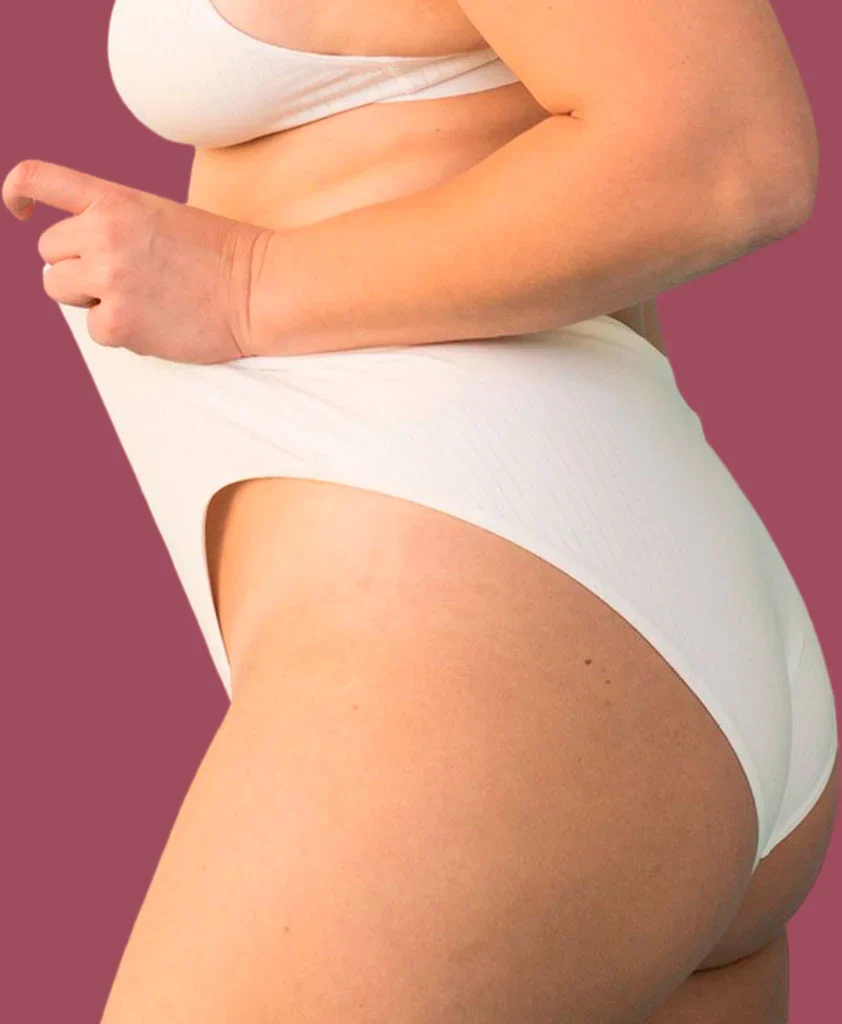 Tratamento para Estrias Clínica de Estética Perto de Mim - ultrassom microfocado - estrias vermelhas tratamento, estrias brancas tratamento