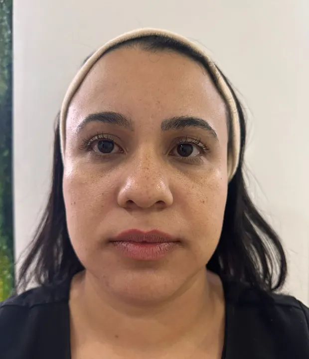 Realize o sonho de ter uma pele mais jovem e radiante! A Clínica Soul Musa oferece o tratamento de rejuvenescimento facial indolor através do ultrassom microfocado, ideal para quem busca resultados eficazes e naturais. Livre-se das marcas do tempo e recupere sua autoestima. Agende uma visita em nossa clínica no Morumbi e descubra o segredo para uma aparência renovada.