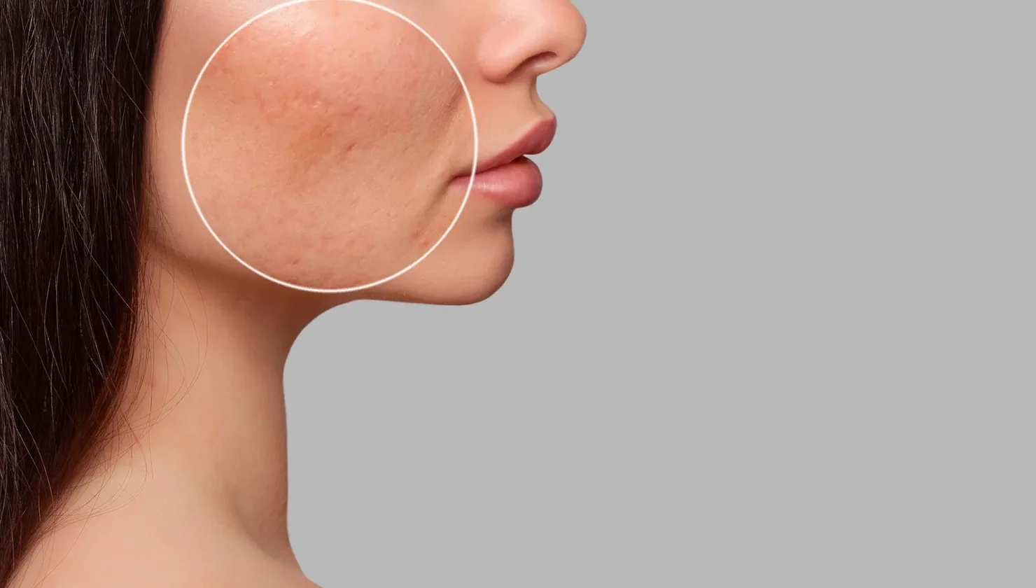 Tratamento para cicatriz de Acne - Soul Musa - Clínica de Estética em São Paulo