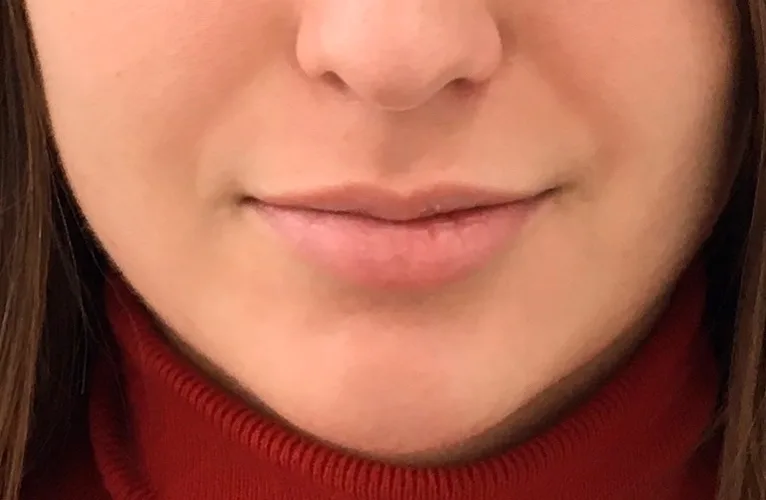 Prenchimento Labial Antes e depois Clínica de estética Soul Musa - Vila Andrade