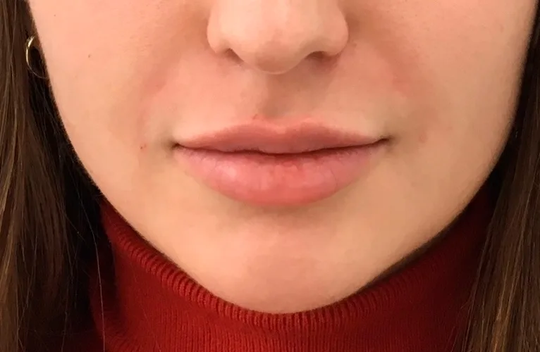 Prenchimento Labial Antes e depois Clínica de estética Soul Musa - Vila Andrade