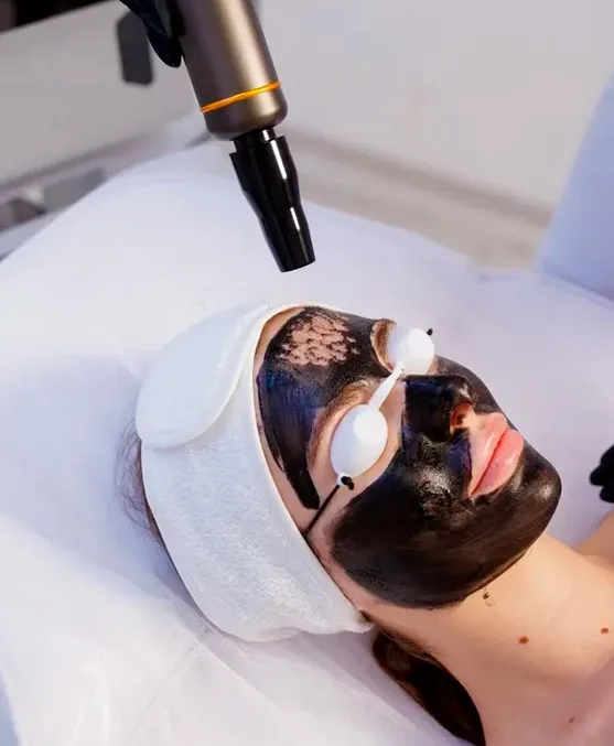 Peeling de hollywood Soul Musa - Clínica de estética em São Paulo