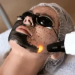 Aplicação da máscara de carbono no rosto