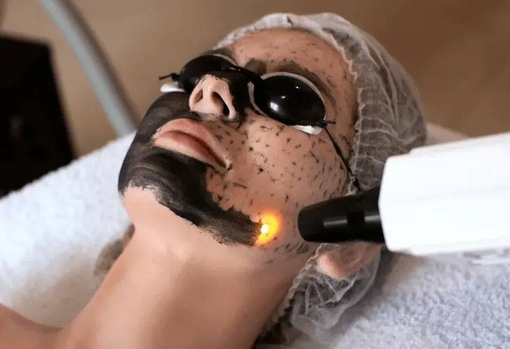 Aplicação da máscara de carbono no rosto