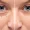 Blefaroplastia Sem Corte: Rejuvenesça Seu Olhar com o Jato de Plasma e Conforto Absoluto!