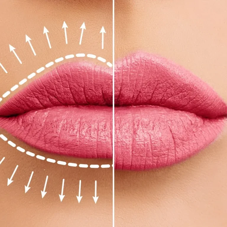 Realce a beleza dos seus lábios com preenchimento labial no Morumbi e Vila Andrade. Técnica avançada com ácido hialurônico para definição, hidratação e resultado natural.