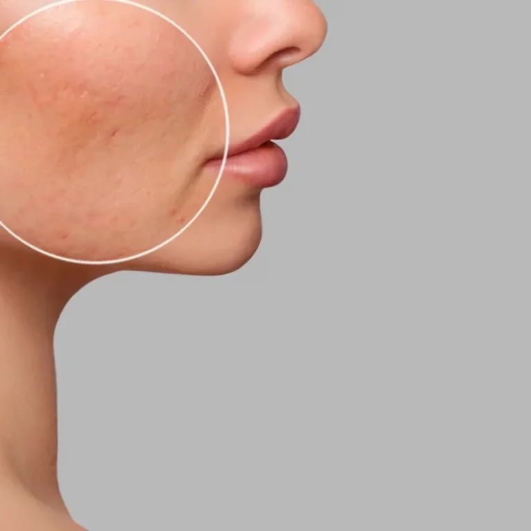 Tratamento para cicatriz de Acne - Soul Musa - Clínica de Estética em São Paulo